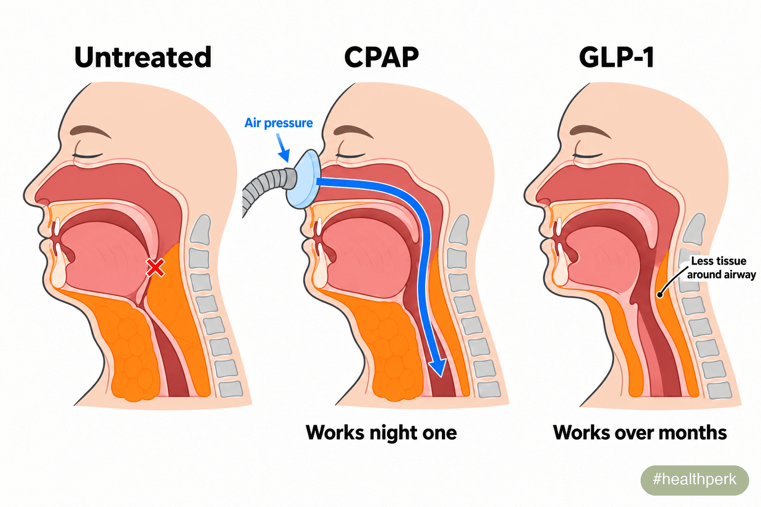 Infographic comparing how CPAP and GLP-1 drugs reduce airway collapse in obstructive sleep apnea